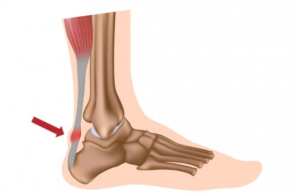 Therapia - Physiotherapy for Achilles Tendonitis
