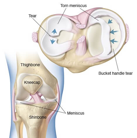Is it good to walk with a torn inner meniscus? - Natural Wellbeing