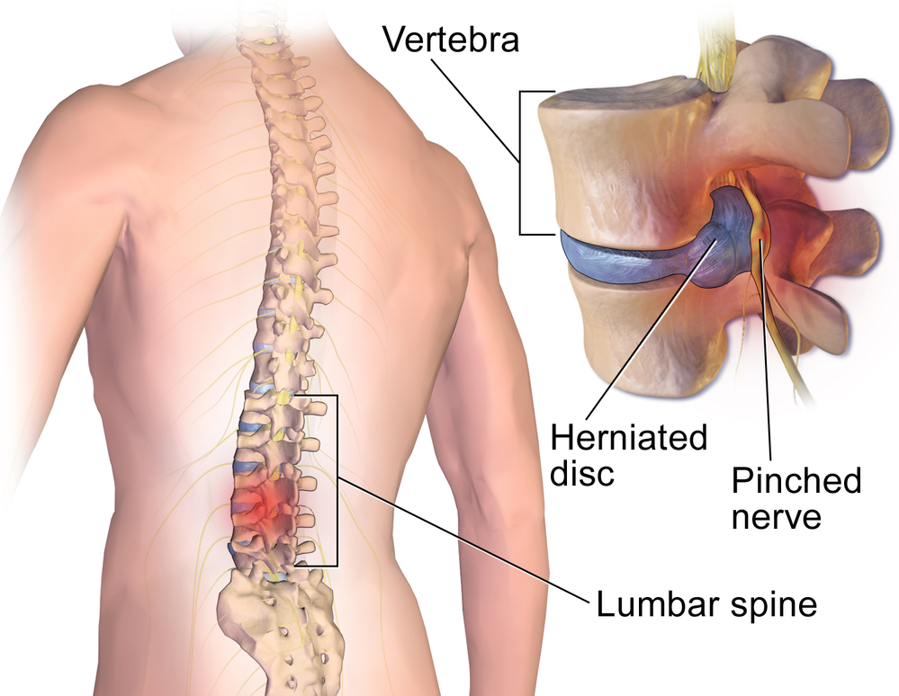 Low back pain, Sciatica, Disc Herniation - Everything You Need To
